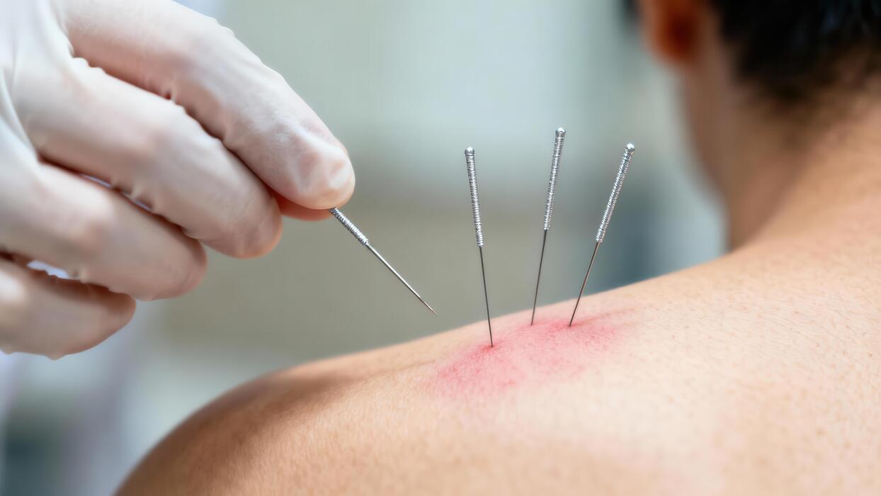 Acupuncture Treatment Session Acupuncturist inserting a needle during a Traditional Chinese Medicine treatment