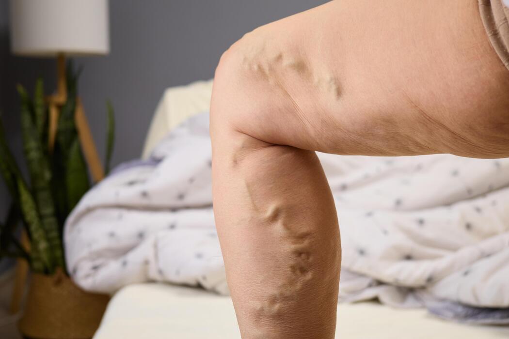 Patient with visible varicose veins on their leg at a vein clinic